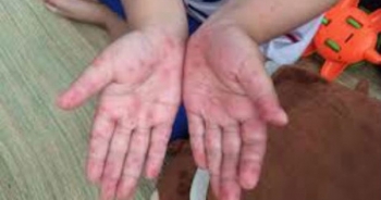 Lo ngại chủng vi rút Enterovirus 71 tái xuất gây tay - chân - miệng