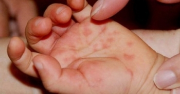 Những dấu hiệu “tố cáo” con bạn mắc tay chân miệng