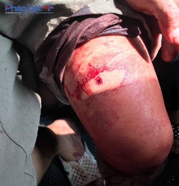 Nhiều khả năng các đối tượng côn đồ đã bắn bằng đạn hoa cải, khiến các nạn nhân trúng nhiều mảnh đạn ghém.