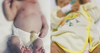 Bé gái sơ sinh chân tay lở loét, vì mắc phải bệnh giang mai bẩm sinh