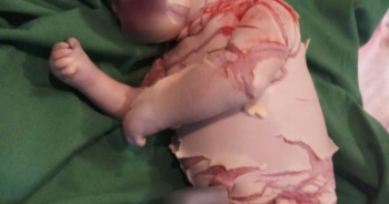 Bé sơ sinh ở Lào Cai mắc bệnh vảy cá hiếm gặp