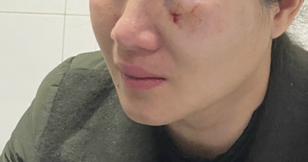 Người phụ nữ bị hành hung gây tổn hại sức khoẻ 16%: Vì sao TAND huyện Ứng Hoà lại cho các đối tượng hưởng án treo?