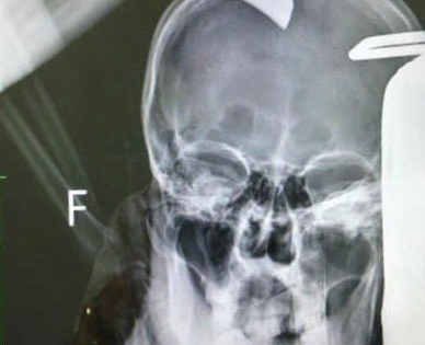 Quảng Ninh: Bênh người yêu của bạn, nam thanh niên nhập viện cùng con dao vẫn găm trên đầu