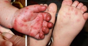 Đã có đủ thuốc điều trị bệnh tay chân miệng