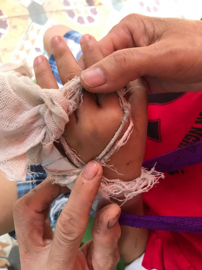 Tay ch&aacute;u Long bị g&atilde;y phải băng b&oacute; lại.