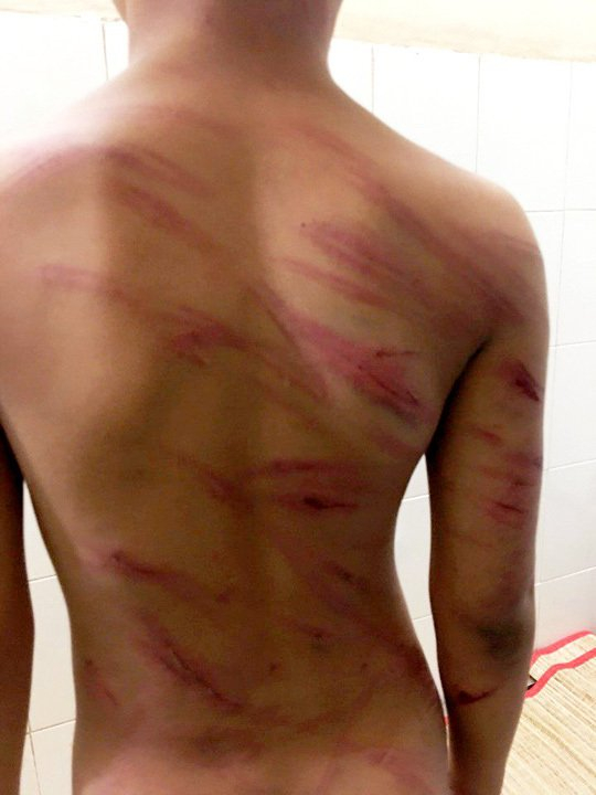 Ch&aacute;u P. bị cha dượng bạo h&agrave;nh t&agrave;n bạo, khiến tr&ecirc;n người đầy vết thương. (Ảnh: b&aacute;o Người lao động)