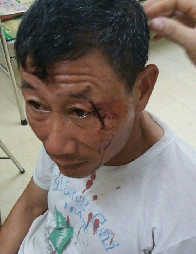 &Ocirc;ng Quyết Đức H&ugrave;ng bị nh&oacute;m c&ocirc;n đồ h&agrave;nh hung với thương t&iacute;ch tr&ecirc;n mặt.