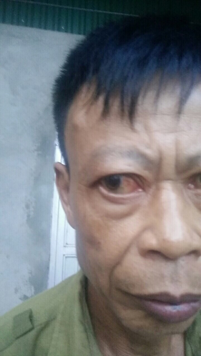 &Ocirc;ng Thụ c&oacute; nguy cơ hỏng mắt do H&ugrave;ng đ&aacute;nh.
