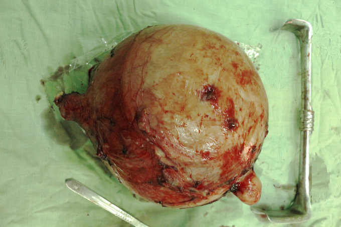 Khối u xơ nặng gần 6kg. Ảnh: BVCC