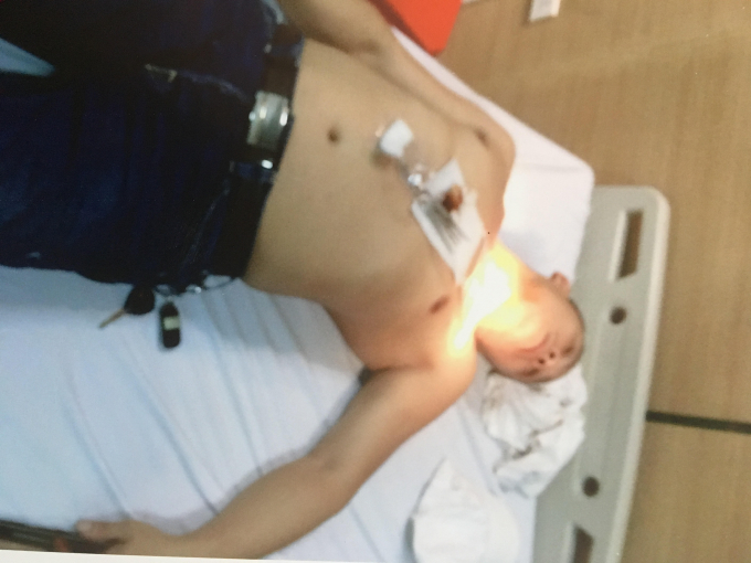 &Ocirc;ng Quảng được cấp cứu tại viện với vết thương tr&ecirc;n cổ (ảnh do gia đ&igrave;nh nạn nh&acirc;n cung cấp).