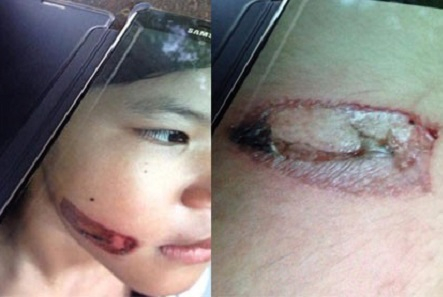 Những vết thương để lại tr&ecirc;n cơ thể b&eacute; g&aacute;i.