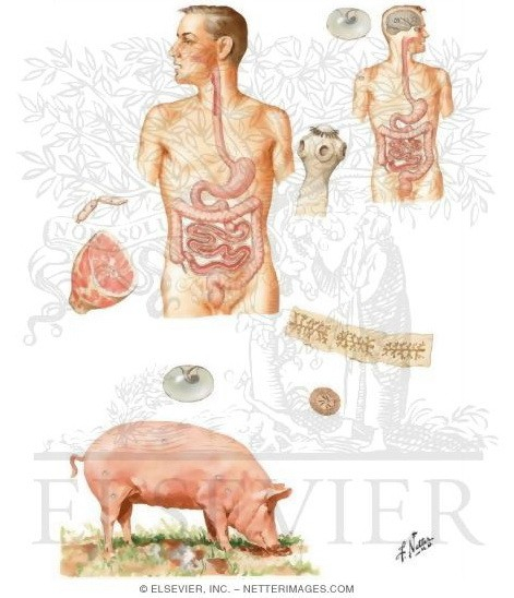 Bệnh lợn &nbsp;gạo c&oacute; t&ecirc;n khoa học Cysticercus cellulosae l&agrave; bệnh g&acirc;y ra bởi ấu tr&ugrave;ng s&aacute;n d&acirc;y lợn, c&oacute; t&ecirc;n khoa học Toenia solium.