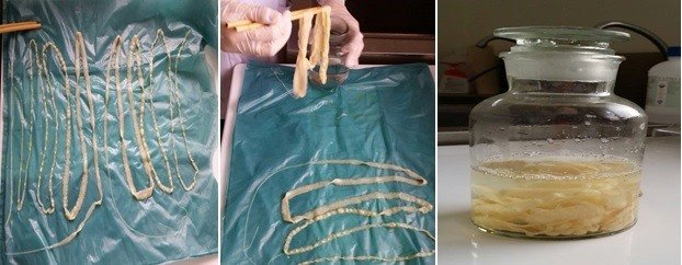 108 người ở B&igrave;nh Phước nhiễm ấu tr&ugrave;ng s&aacute;n lợn gạo.