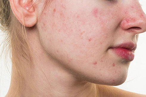 Mụn nhọt:Những v&ugrave;ng da bị tổn thương do mụn nhọt hoặc vi&ecirc;m nhiễm da l&acirc;u ng&agrave;y sẽ c&oacute; nguy cơ xuất hiện ung thư da hơn c&aacute;c vị tr&iacute; da kh&aacute;c. L&yacute; do l&agrave; bởi qu&aacute; tr&igrave;nh t&aacute;i tạo lớp biểu b&igrave; của da bị ảnh hưởng, chức năng bảo vệ cơ thể của da k&eacute;m hơn.