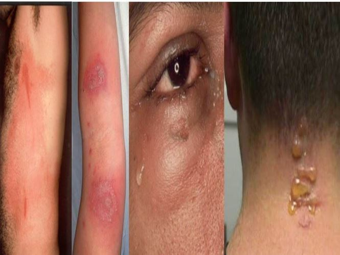 Tổn thương tr&ecirc;n da của bệnh nh&acirc;n do bị kiến ba khoang đốt