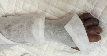 Sự thật về hạt đậu hút được mọi chất độc do côn trùng cắn