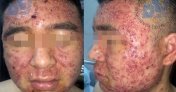 Mụn mủ nghiêm trọng vì chữa mụn trứng cá bằng thuốc Nam