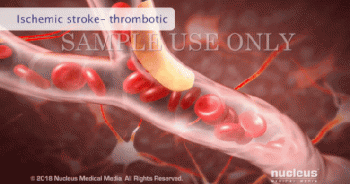 [Video]: Cách một cơn đột quỵ xảy ra và tàn phá não bộ