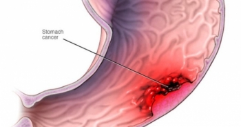 Tất cả những điều bạn cần biết để ngừa ung thư dạ dày
