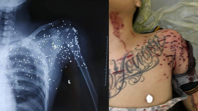 Phim chụp cho thấy các vết đạn xuất hiện dày đặc nơi vùng phổi của nạn nhân.