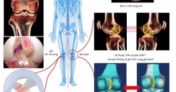 Vinmec tái tạo chính xác dây chằng chéo trước khớp gối với phương pháp “ánh xạ giải phẫu” độc quyền