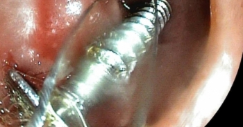 Đi học ở trường mầm non, bé 3 tuổi nghi nuốt phải đinh vít tử vong