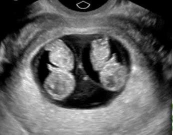 Hy hữu: Việt Nam phát hiện song thai cùng trứng nhưng khác kiểu gen