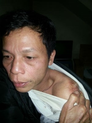 Anh H&ugrave;ng vừa kể lại, vừa chỉ những vết sẹo do bị nhục h&igrave;nh từ năm 1995.