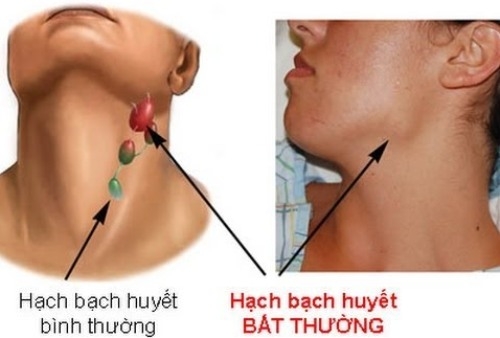 Hạch bạch huyết ở cổ sưng l&ecirc;n l&agrave; một trong những dấu hiệu của&nbsp;ung thư m&aacute;u. Ảnh:&nbsp;News.