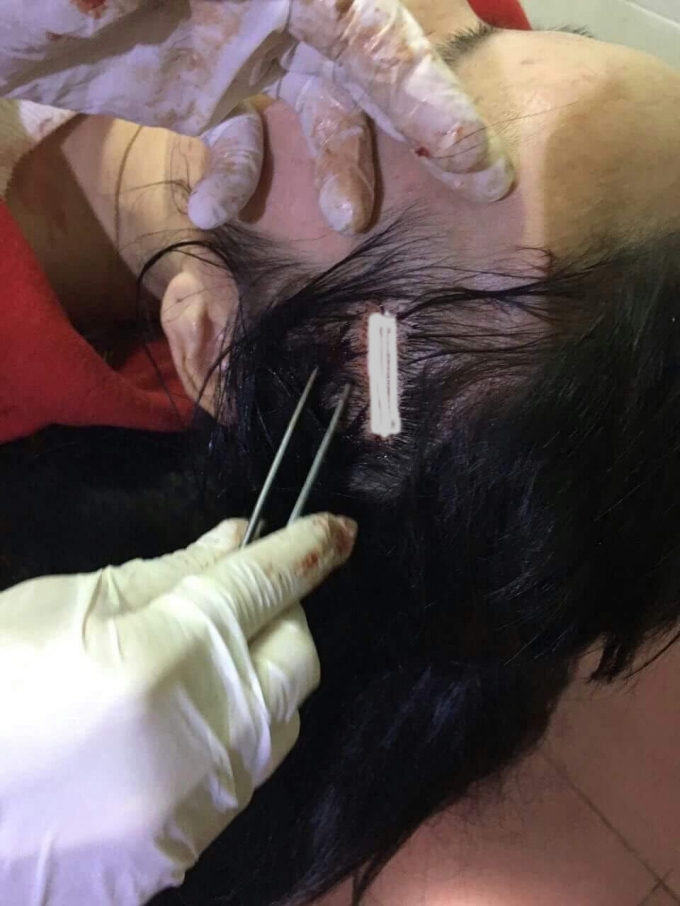 Vết thương ở đầu khiến chị Ngọc phải kh&acirc;u nhiều chục mũi.