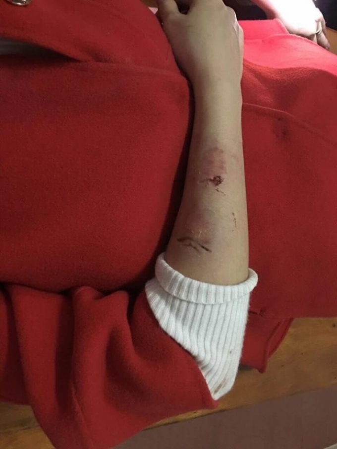 V&agrave; chằng chịt vết thương ở tay do dao, k&eacute;o g&acirc;y ra.