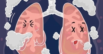 8 dấu hiệu cảnh báo phổi có vấn đề