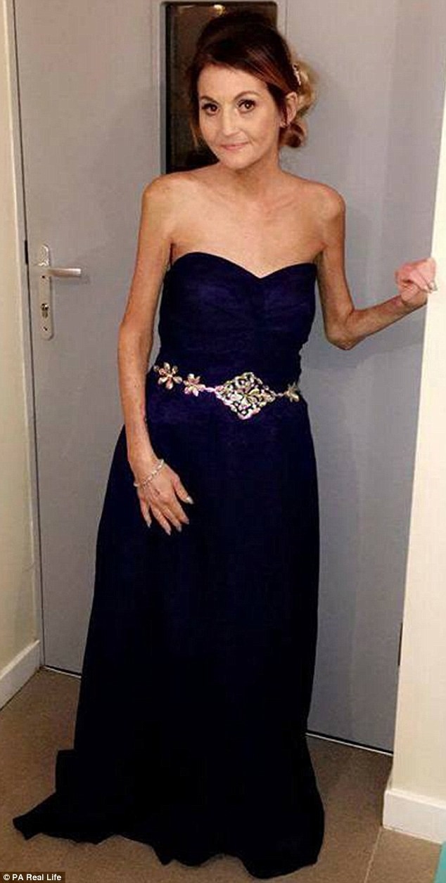 Lorraine Burnet&nbsp;kh&ocirc;ng bao giờ tin rằng m&igrave;nh bị mất một ch&acirc;n chỉ v&igrave; đeo gi&agrave;y cao g&oacute;t. Ảnh:&nbsp;PA Real Life.