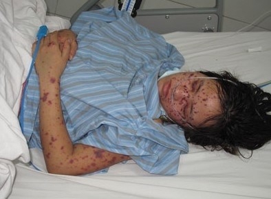 Bệnh nh&acirc;n V mắc bệnh vi&ecirc;m n&atilde;o m&ocirc; cầu. Ảnh: DT.