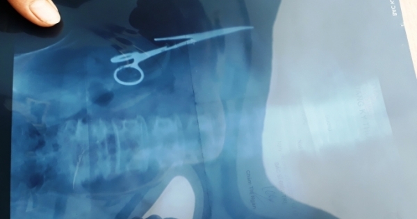 Hoảng hồn phát hiện kéo bị “bỏ quên” trong bụng sau gần 20 năm phẫu thuật