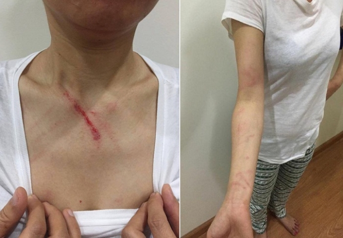 Những vết thương tr&ecirc;n cơ thể chị V&acirc;n sau khi bị đ&aacute;nh v&igrave; nhắc nhở người kh&aacute;c kh&ocirc;ng được nhổ bậy. (Ảnh: FB Khanh Van Do).
