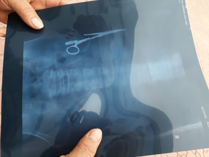 H&igrave;nh dạng chiếc panh y tế bỏ qu&ecirc;n trong bụng &ocirc;ng Nhật gần 20 năm qua phim X-quang.