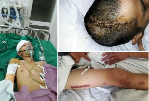 T&ugrave;ng khai bị &ocirc;ng Phương ch&eacute;m 2 nh&aacute;t v&agrave;o đầu, g&atilde;y tay v&agrave; bị con trai &ocirc;ng Phương d&ugrave;ng d&ugrave;i cui d&iacute; nhiều nh&aacute;t v&agrave;o người khiến bị bỏng nặng. Ảnh: PLVN