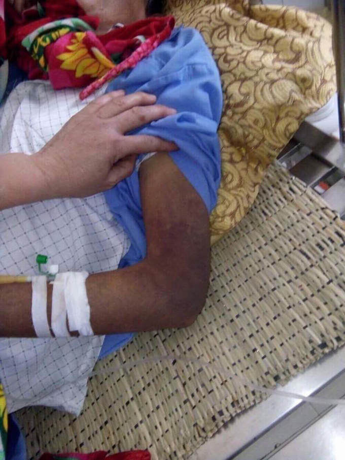 Một c&aacute;nh tay của &ocirc;ng N bị đ&aacute;nh bầm t&iacute;m, đau đớn hơn người đ&aacute;nh &ocirc;ng ch&iacute;nh l&agrave; con trai m&igrave;nh.