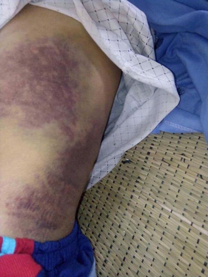 Phần h&ocirc;ng cũng bị