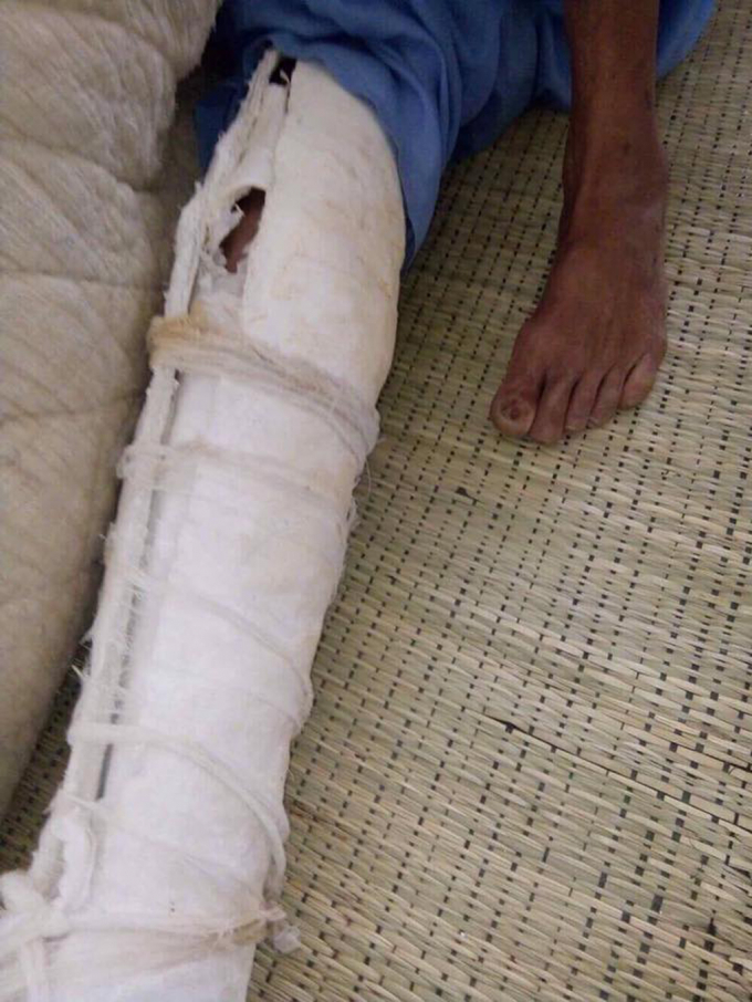 Một ch&acirc;n của &ocirc;ng N phải b&oacute; k&iacute;n do bị con trai đ&aacute;nh.