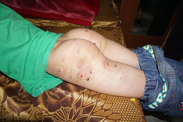 Những vết đ&ograve;n roi chi ch&iacute;t vẫn c&ograve;n tr&ecirc;n người b&eacute; N.