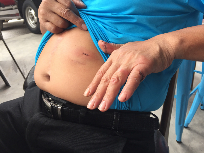 &Ocirc;ng Đinh Xu&acirc;n Giang bị thương ở bụng v&agrave; tay tr&aacute;i.