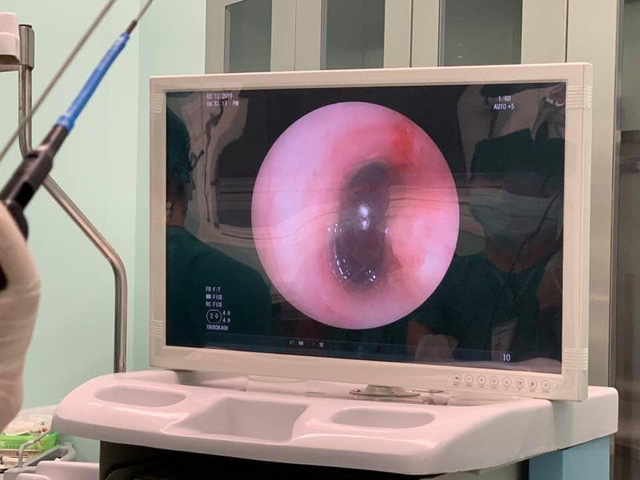 Hạt h&ocirc;ng xi&ecirc;m được ph&aacute;t hiện trong phế quản bệnh nhi qua h&igrave;nh ảnh nội soi