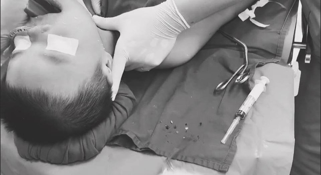 Bệnh nhi đ&atilde; may mắn qua nguy kịch khi b&aacute;c sĩ kẹp vỡ hạt gắp ra ngo&agrave;i, khơi th&ocirc;ng đường thở