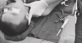 Bé 11 tháng tuổi tử vong vì bị hóc thạch