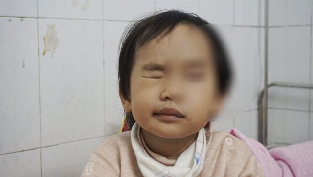 Cảnh b&aacute;o: R&eacute;t đậm khắc nghiệt, nhiều trẻ liệt mặt, m&eacute;o miệng v&igrave; nhiễm lạnh đột ngột