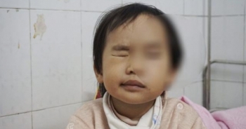 Cảnh báo: Rét đậm khắc nghiệt, nhiều trẻ liệt mặt, méo miệng vì nhiễm lạnh đột ngột