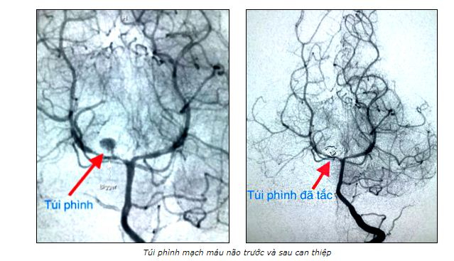 Cứu sống bệnh nhi 3 tuổi bị vỡ ph&igrave;nh mạch n&atilde;o