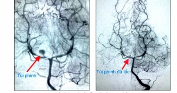 Cứu sống bệnh nhi 3 tuổi bị vỡ phình mạch não